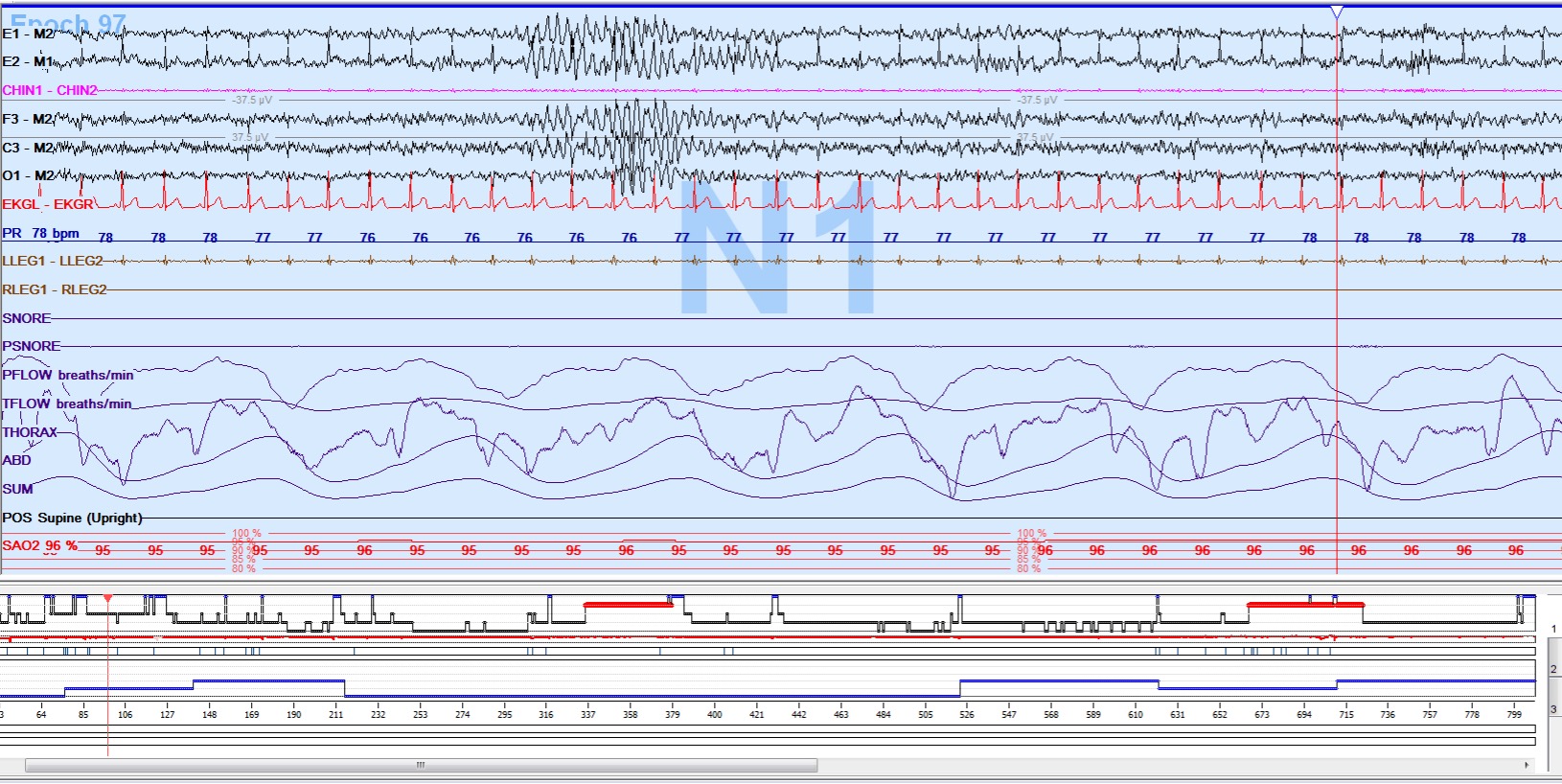 <p>Polysomnogram of Stage N1 Non&ndash;Rapid Eye Movement Sleep