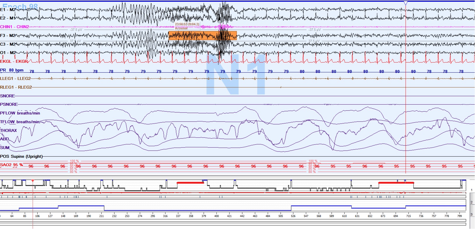 <p>Polysomnogram of Stage N1 Sleep with an Arousal