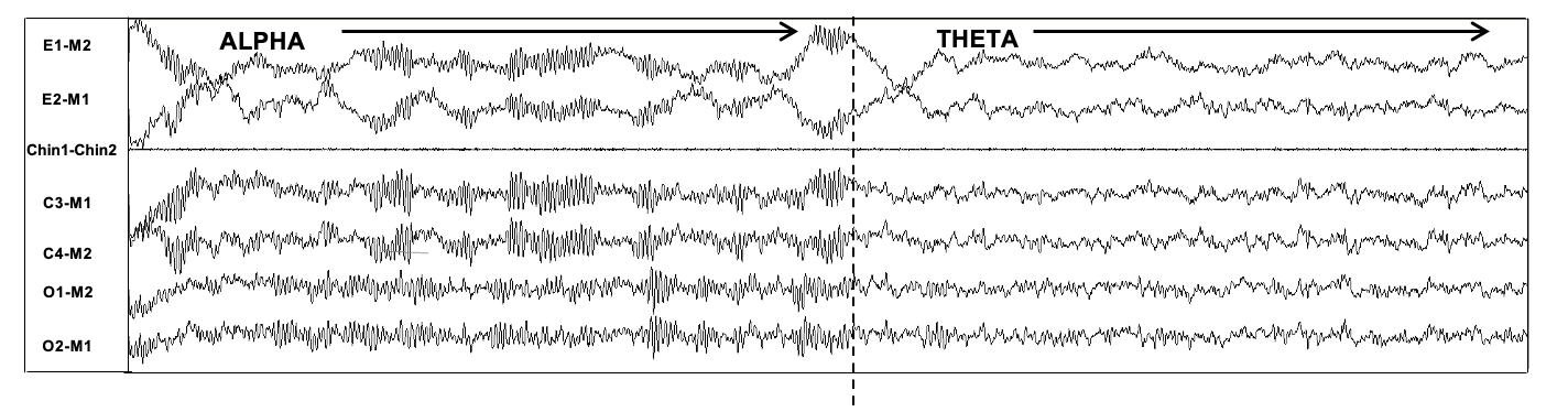 <p>Electroencephalogram Transition from Wakefulness to Stage N1 Non&ndash;Rapid Eye Movement Sleep