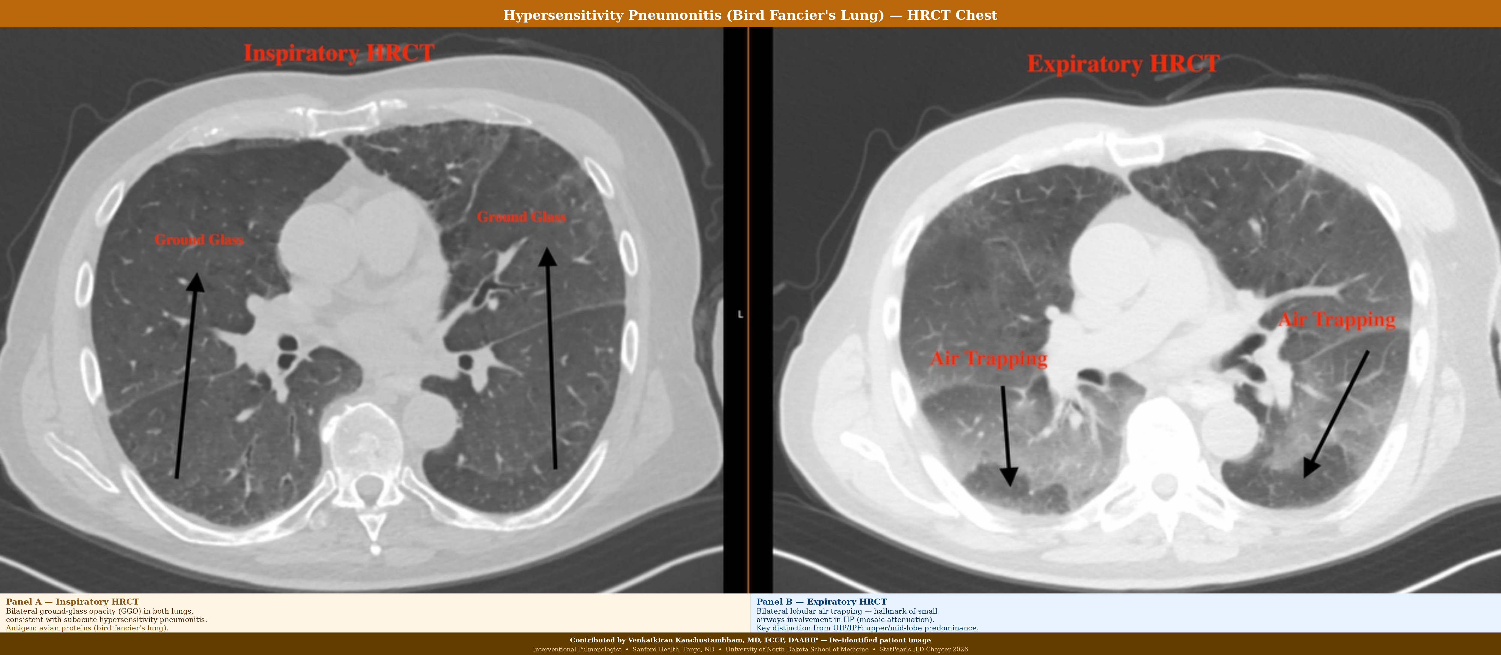 <p>Hypersensitivity Pneumonitis