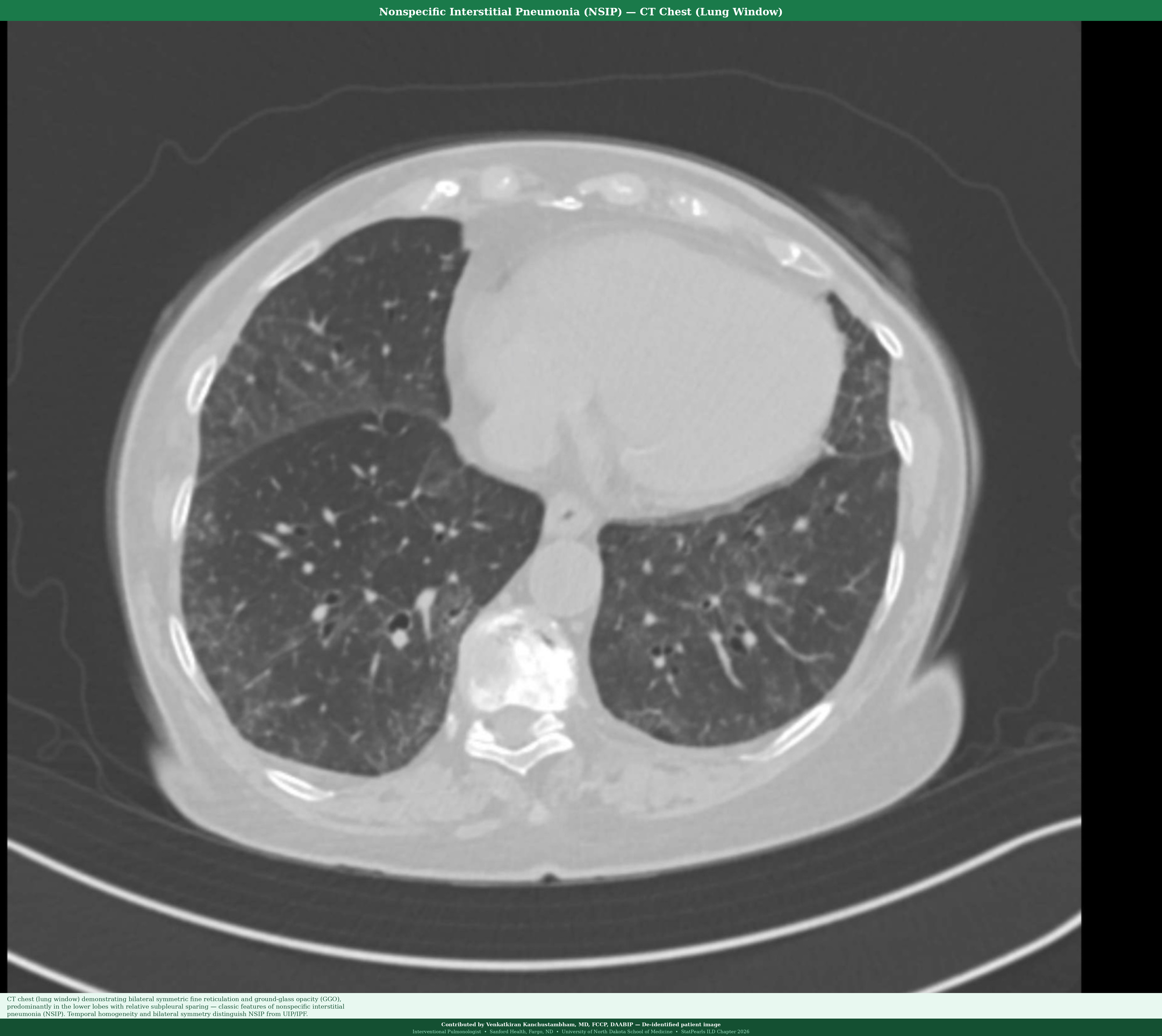 <p>Nonspecific Interstitial Pneumonia