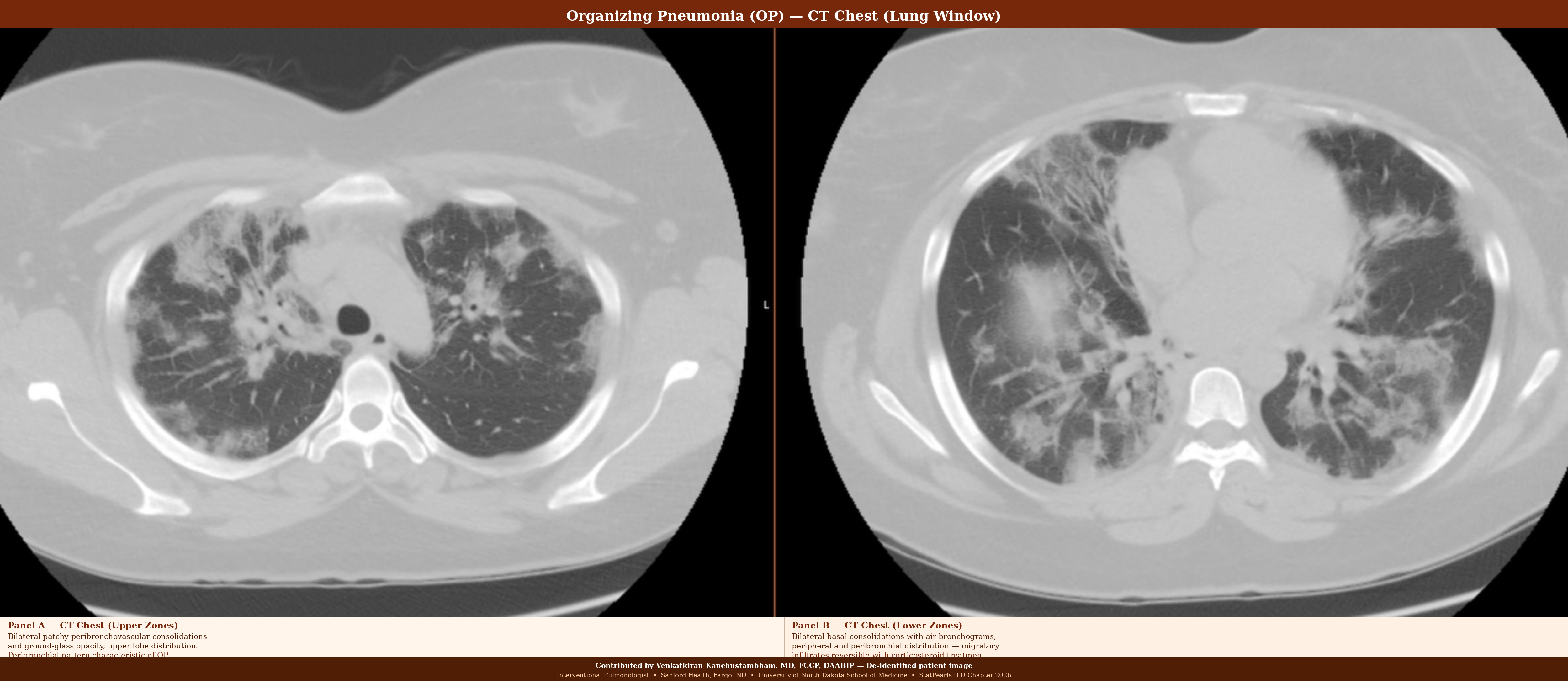 <p>Organizing Pneumonia