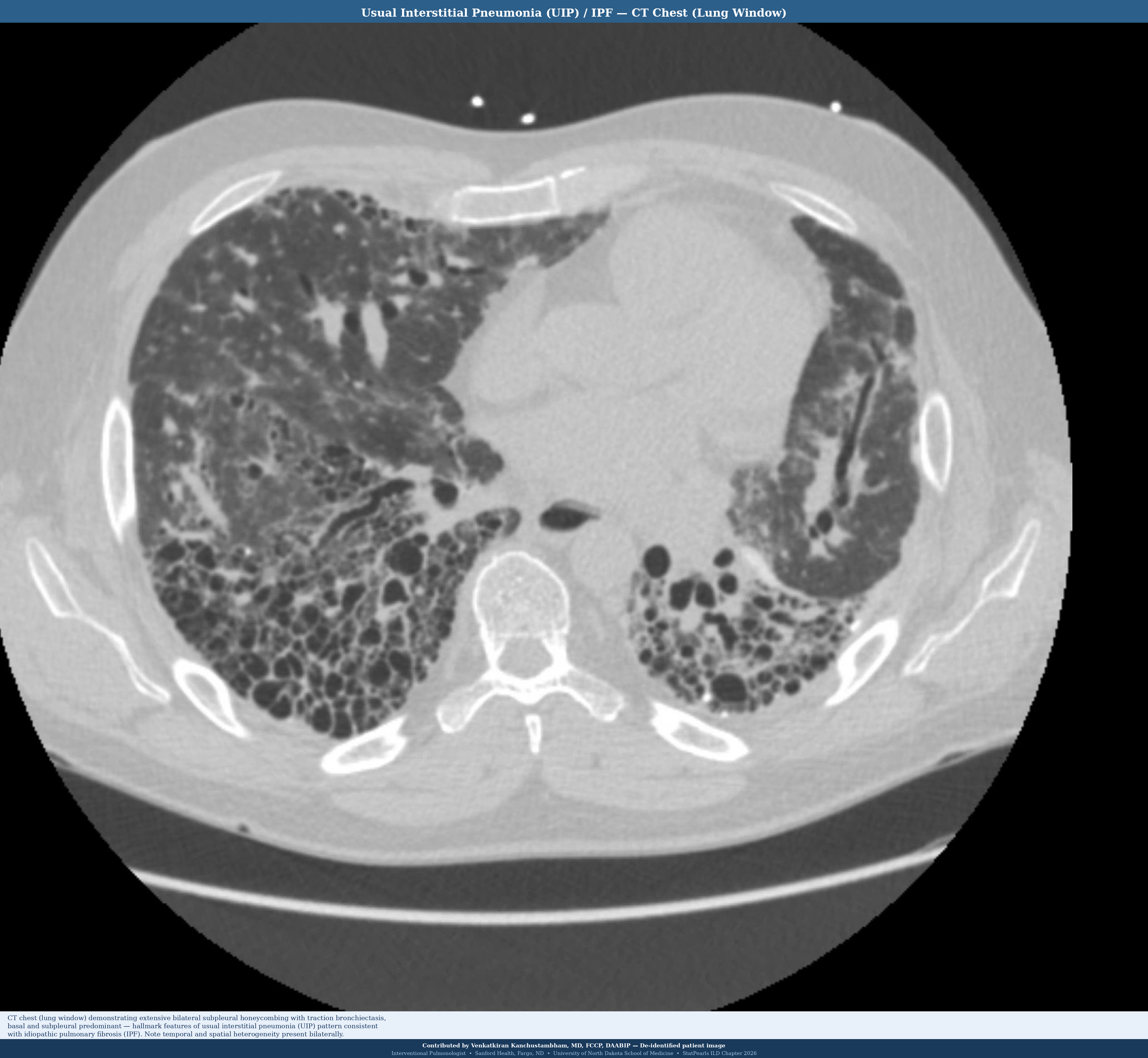 <p>Pattern of Usual Interstitial Pneumonia/ Idiopathic Pulmonary Fibrosis on Computed Tomography Scan