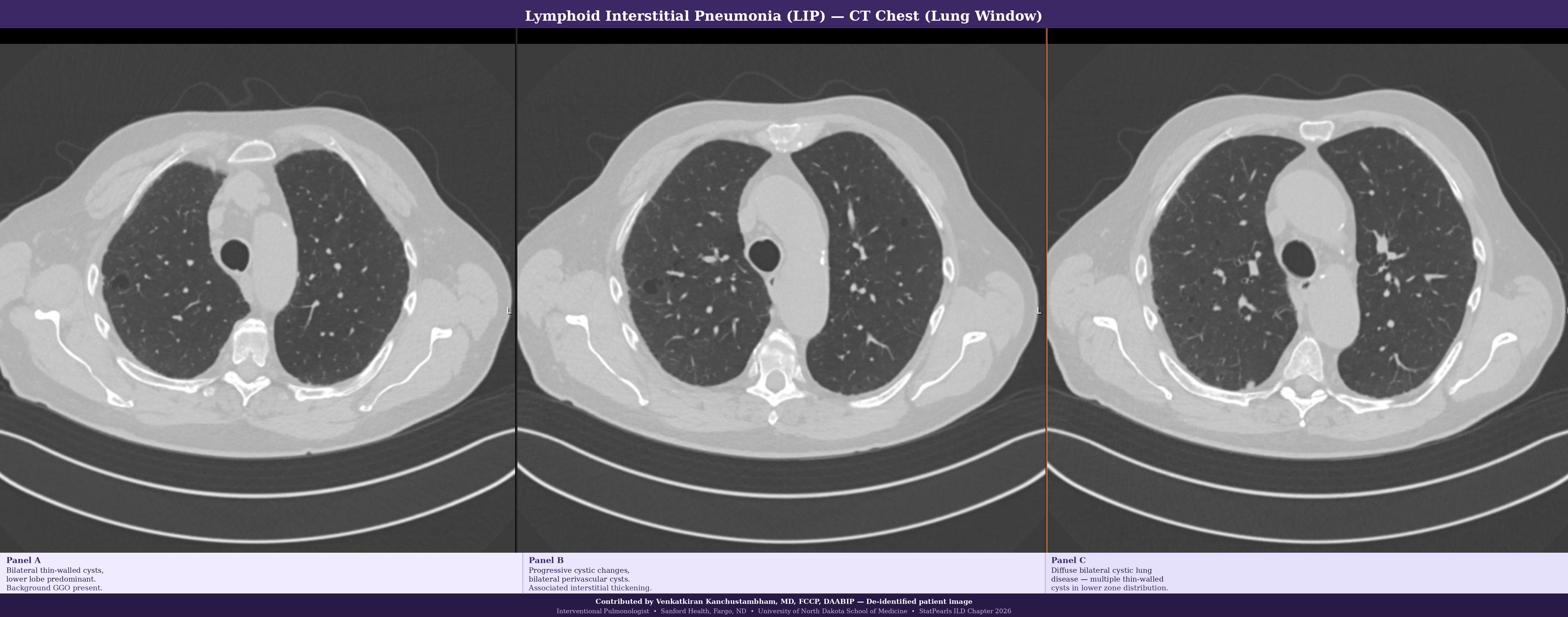 <p>Lymphoid Interstitial Pneumonia