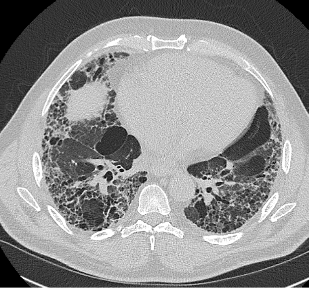 <p>Diffuse Interstitial Lung Disease