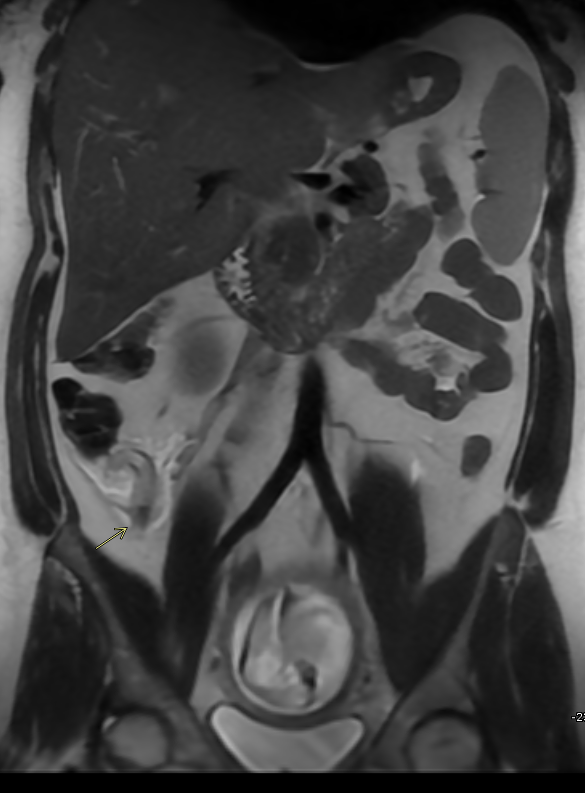 <p>Acute Appendicitis and Intrauterine Pregnancy on Magnetic Resonance Imaging
