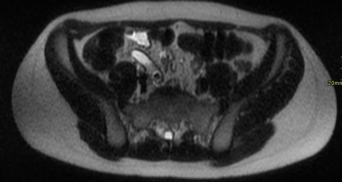 <p>Acute Appendicitis and Appendicolith on Magnetic Resonance Imaging