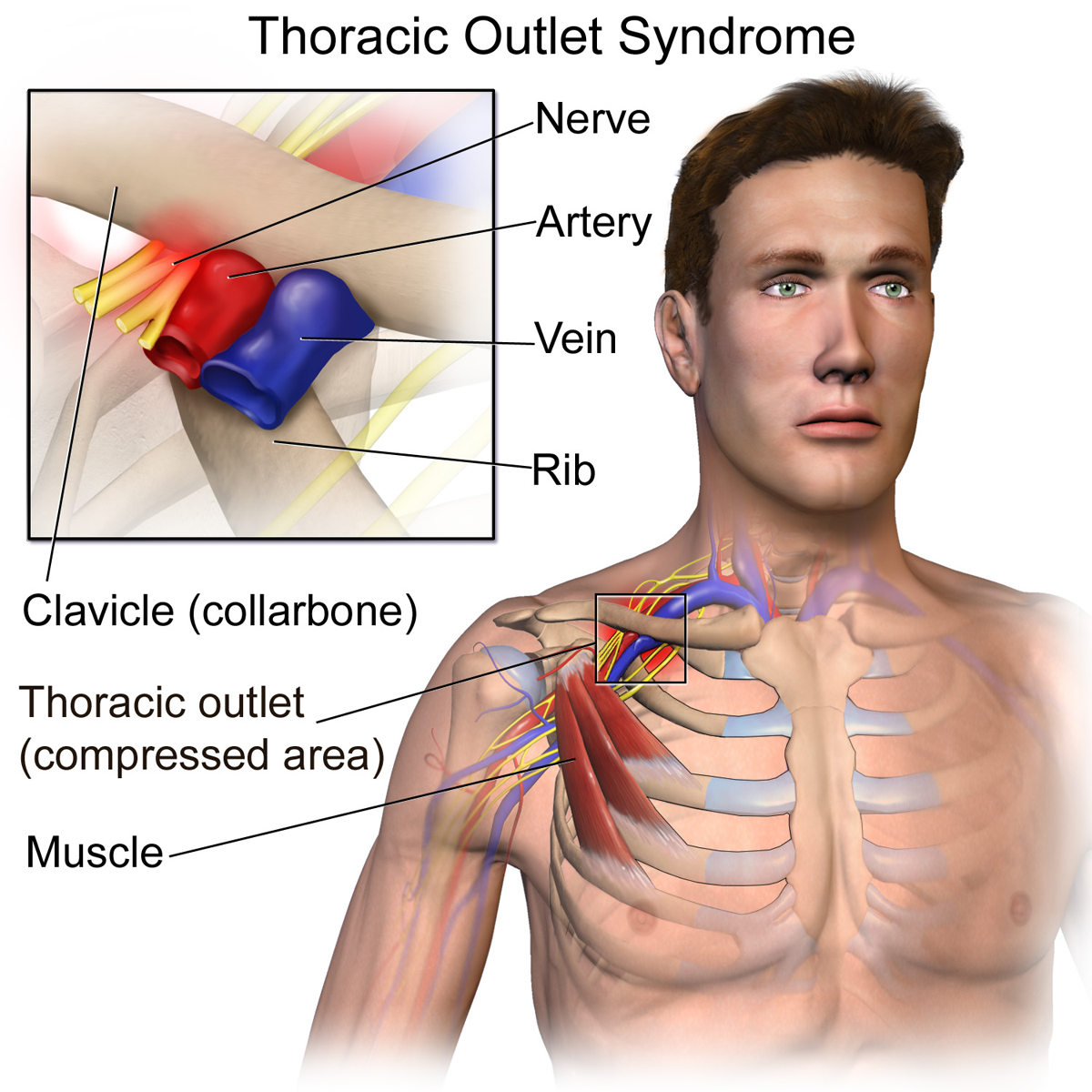 <p>Neurovascular Compression in Thoracic Outlet Syndrome