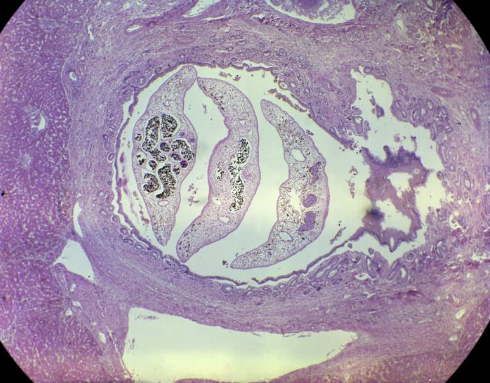 <p>Histopathology of <em>Clonorchis Sinensis