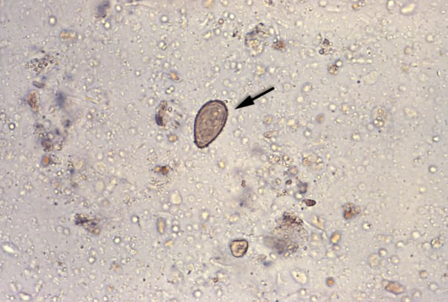 <p>Photomicrograph of Clonorchiasis