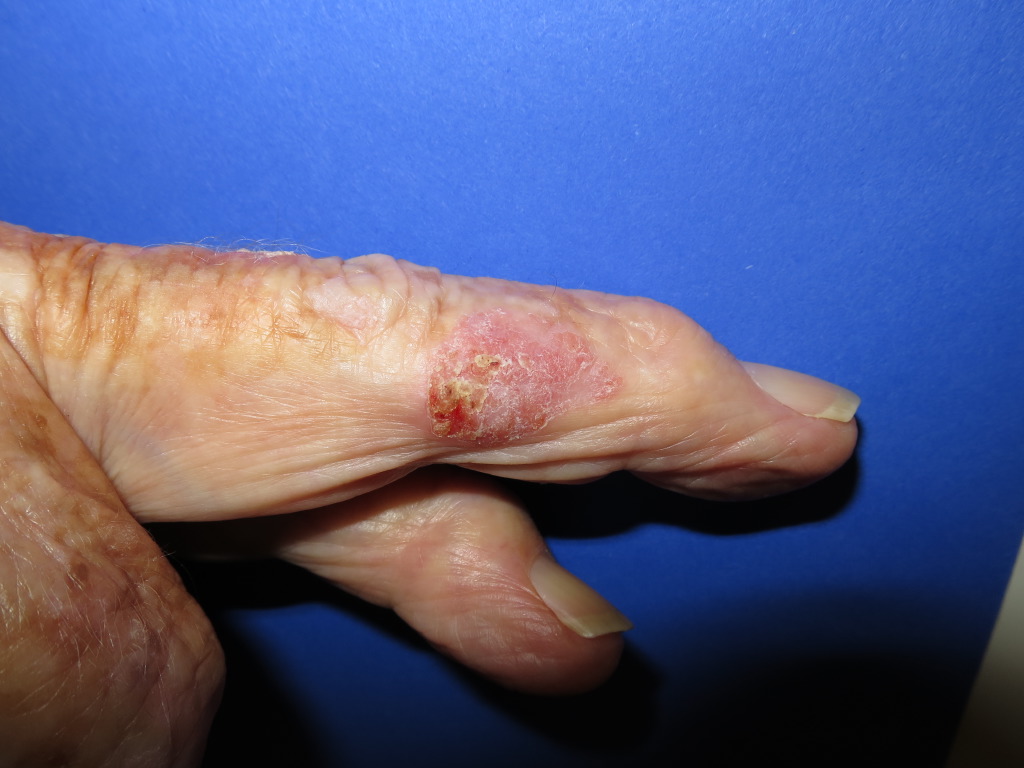 <p>Intraepidermal Carcinoma.</p>