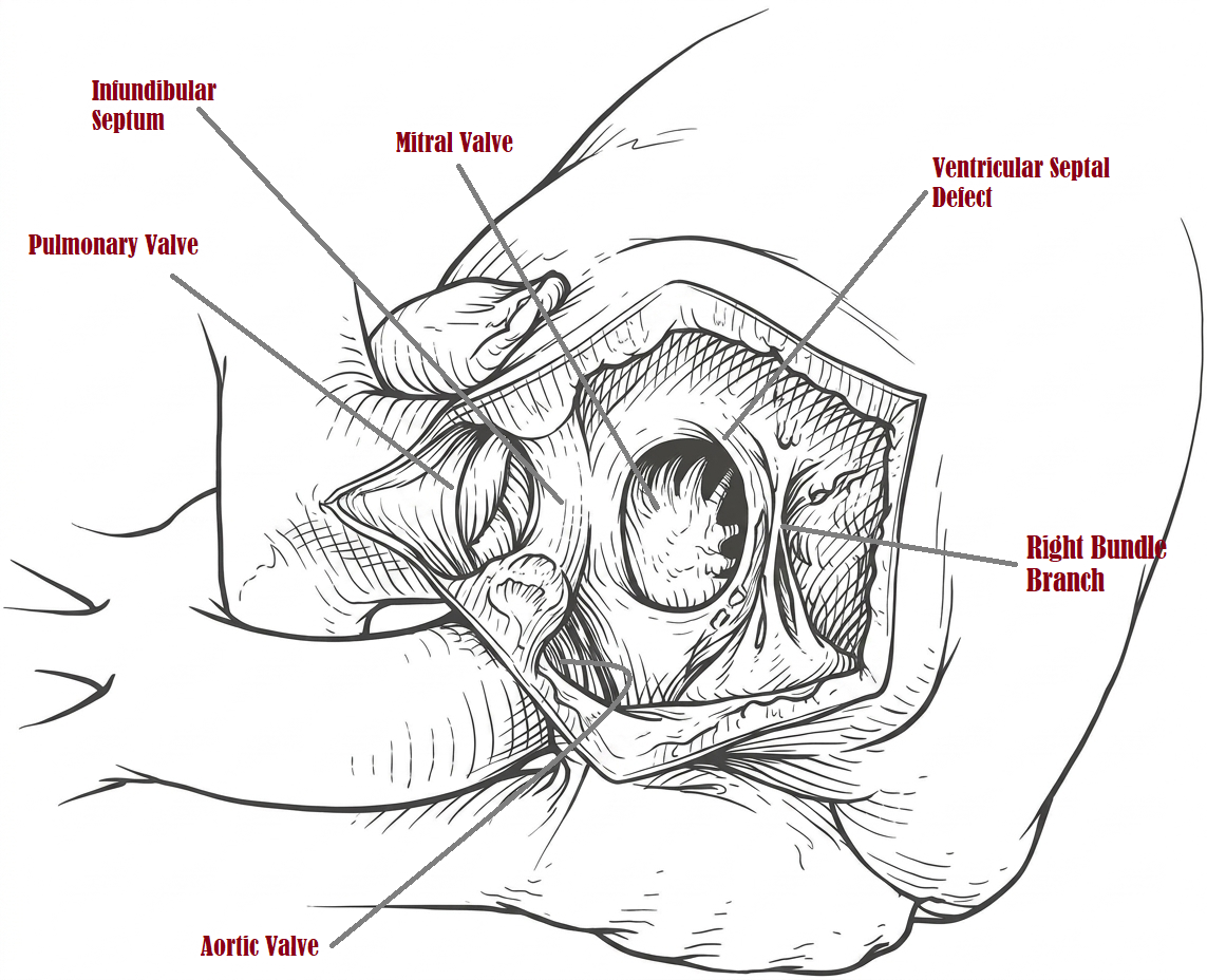 <p>Surgical Anatomy of Double Outlet Right Ventricle