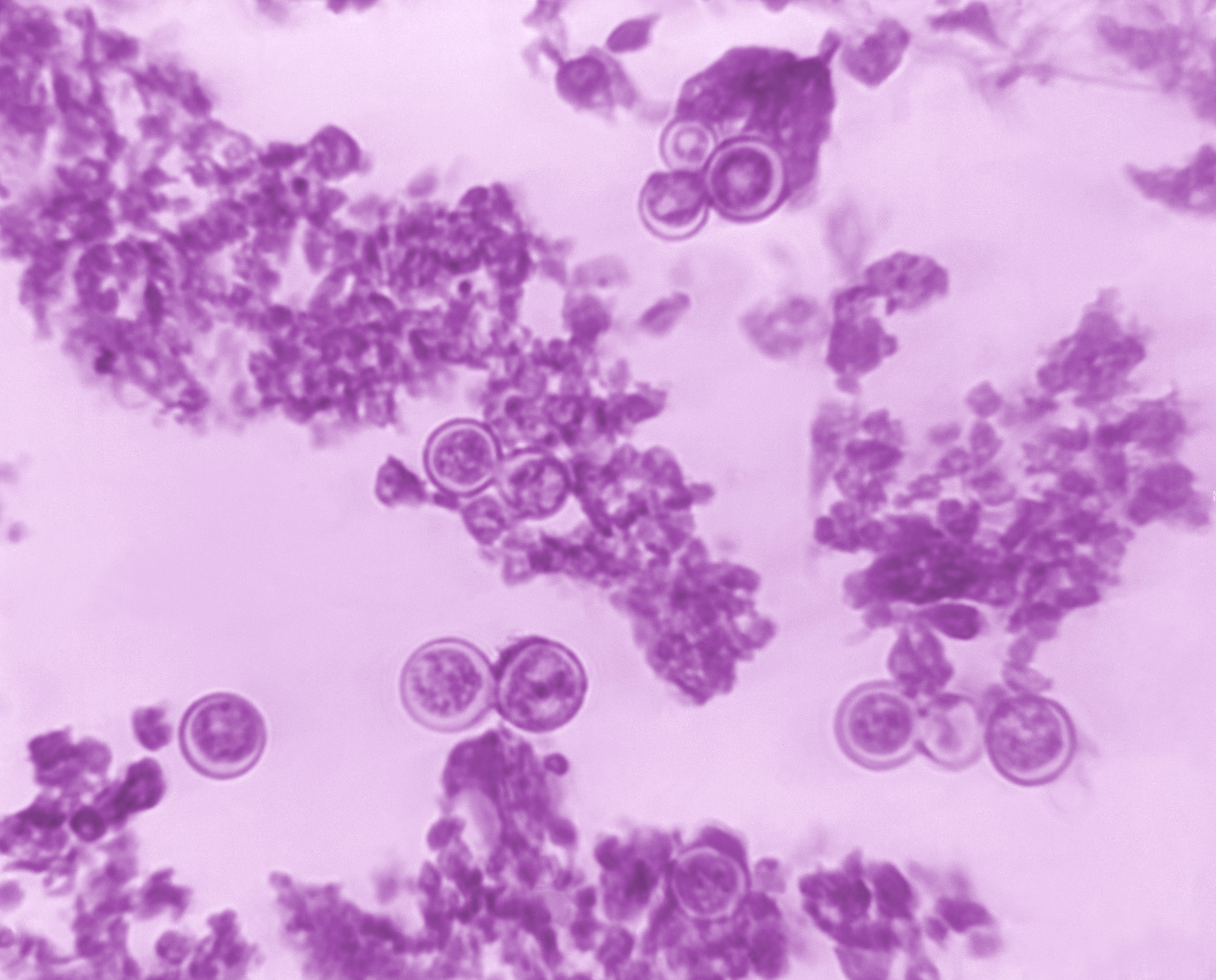 <p><em>Blastomycosis dermatitidis</em> in Lung Tissue