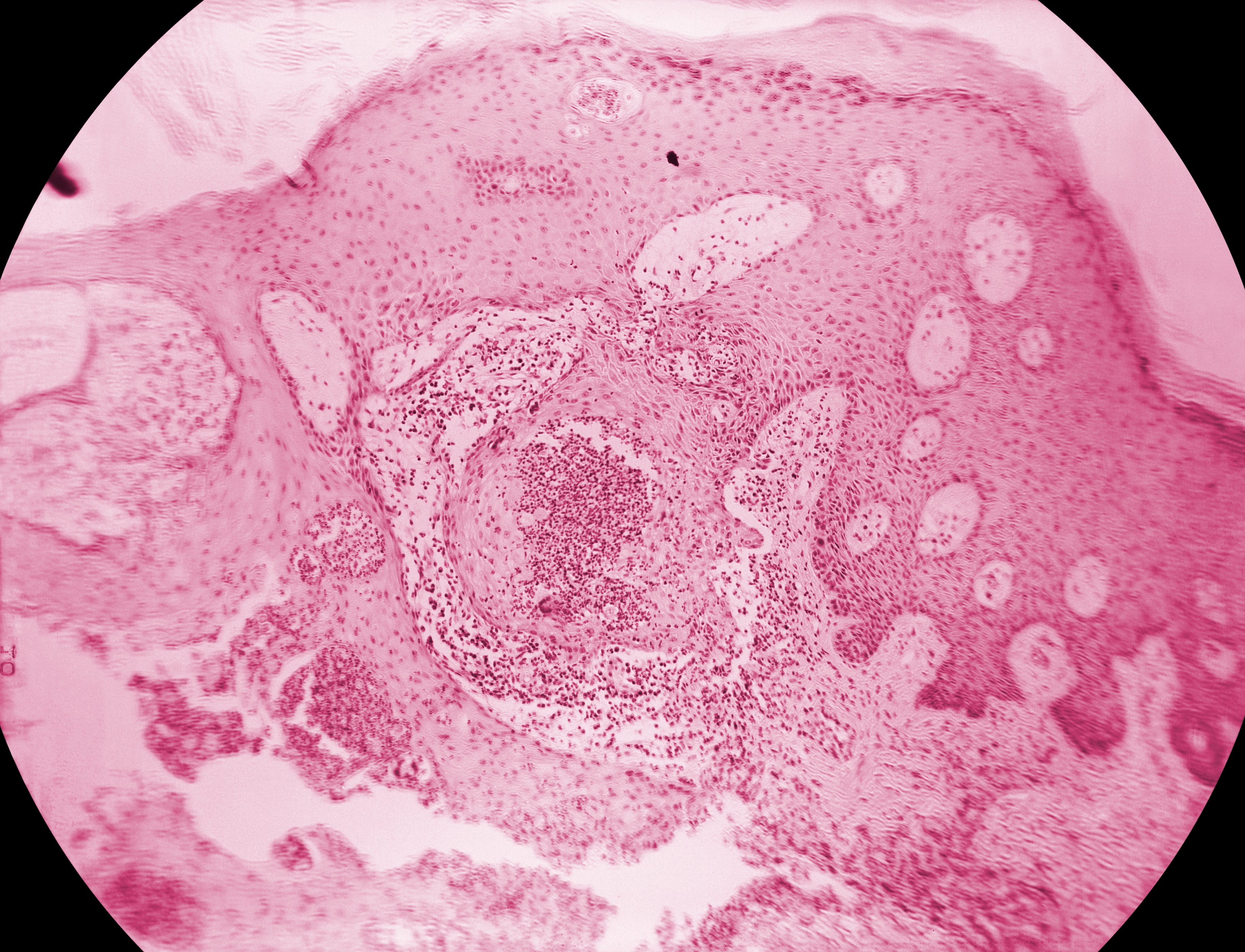 <p><em>Blastomyces dermatitidis</em> of Skin