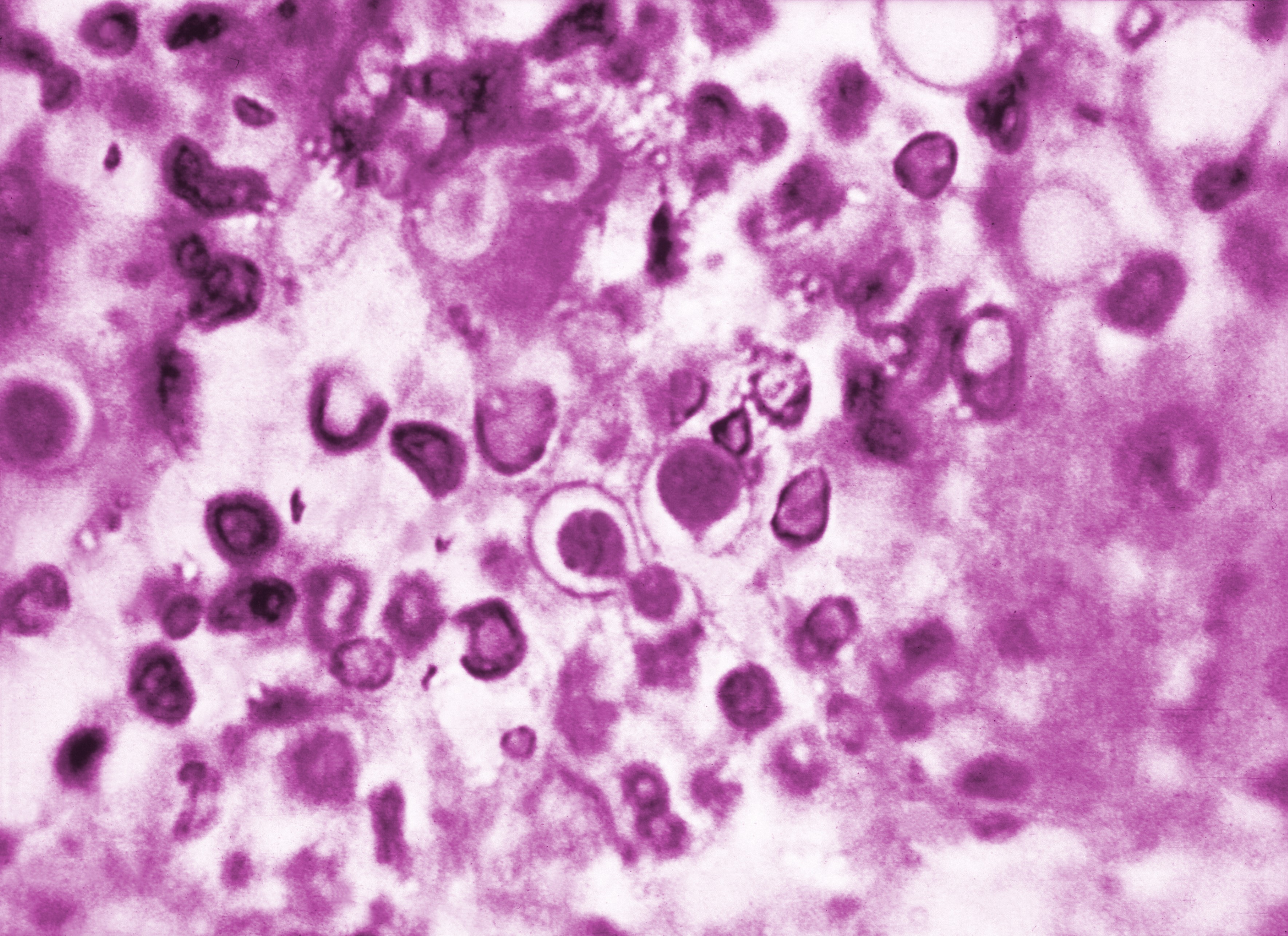 <p><em>Blastomyces dermatitidis
