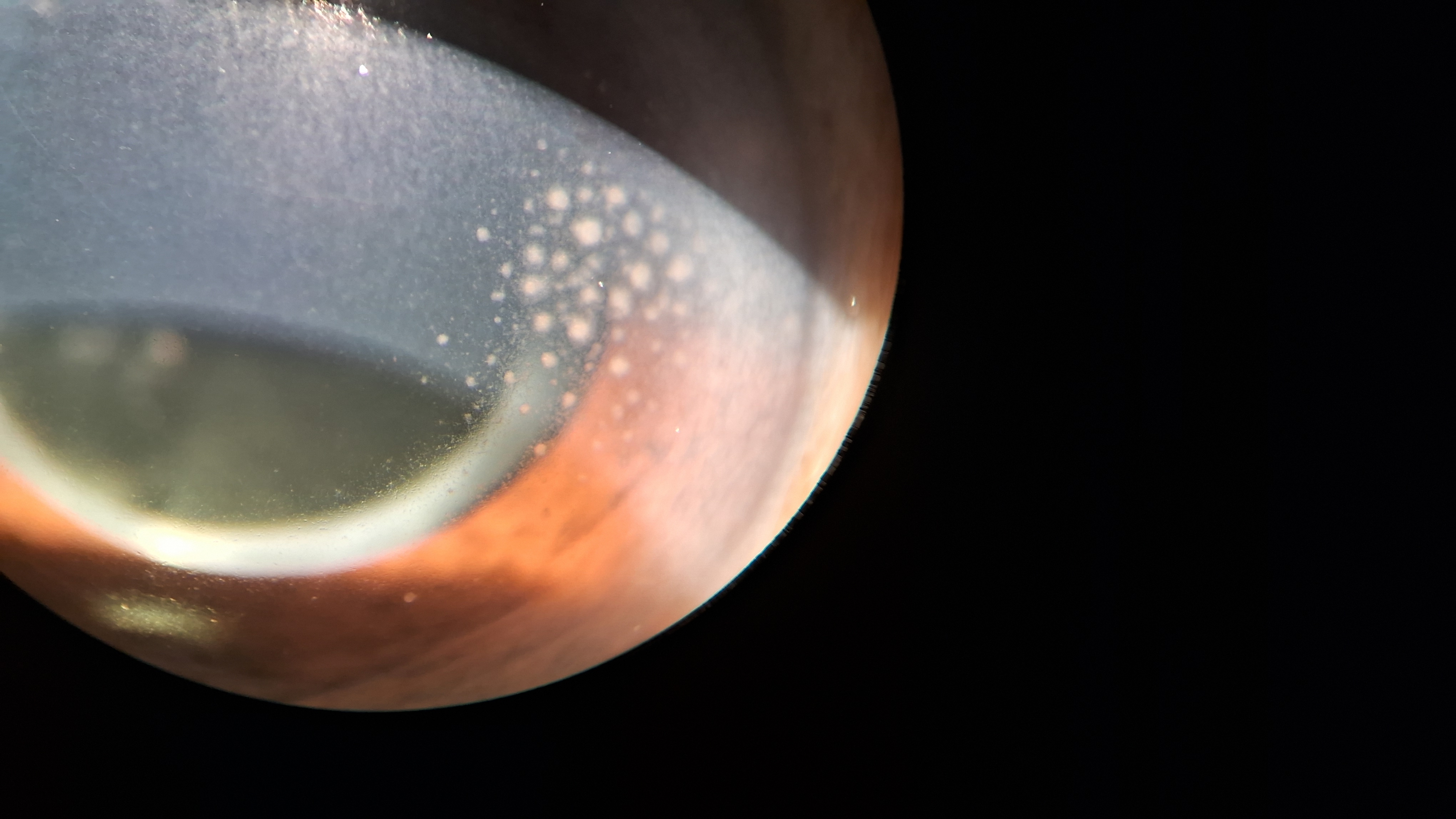 <p>Mutton-Fat Keratic Precipitates