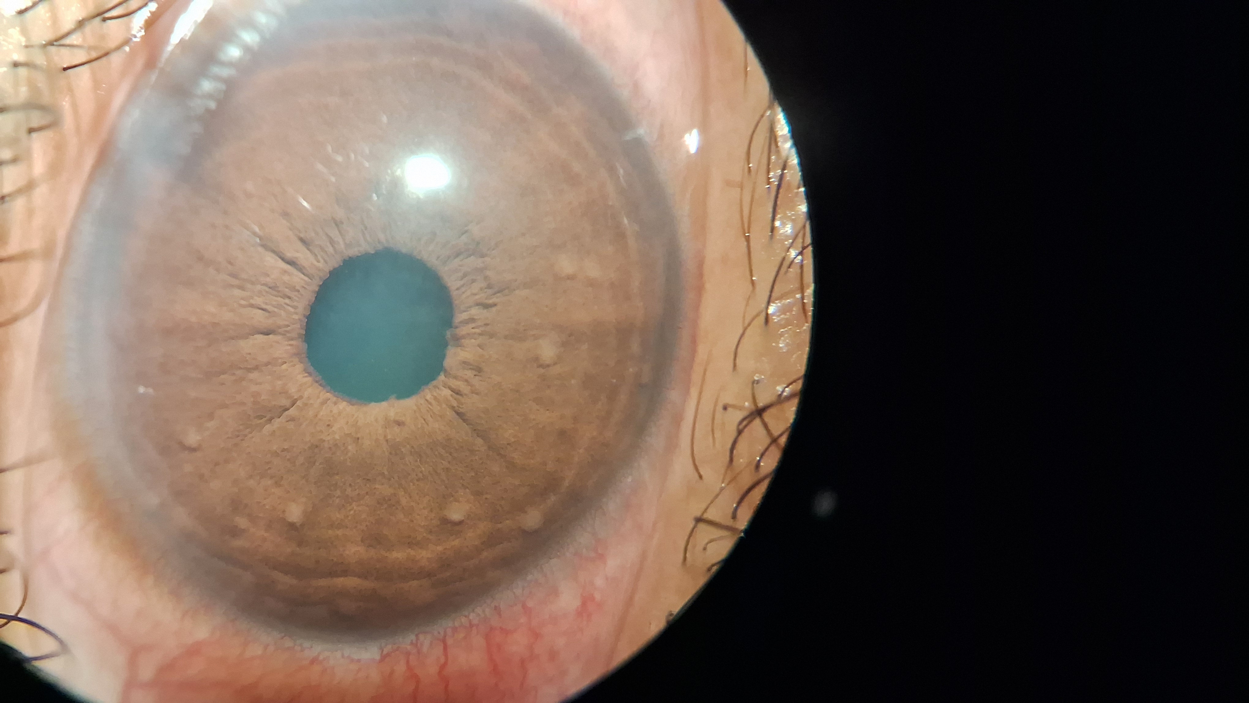 <p>Busacca Nodules in Granulomatous Uveitis
