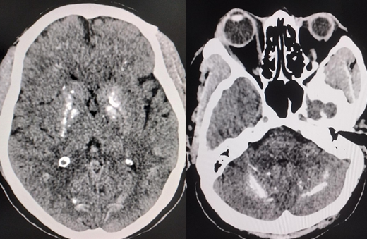 <p>Fahr Disease