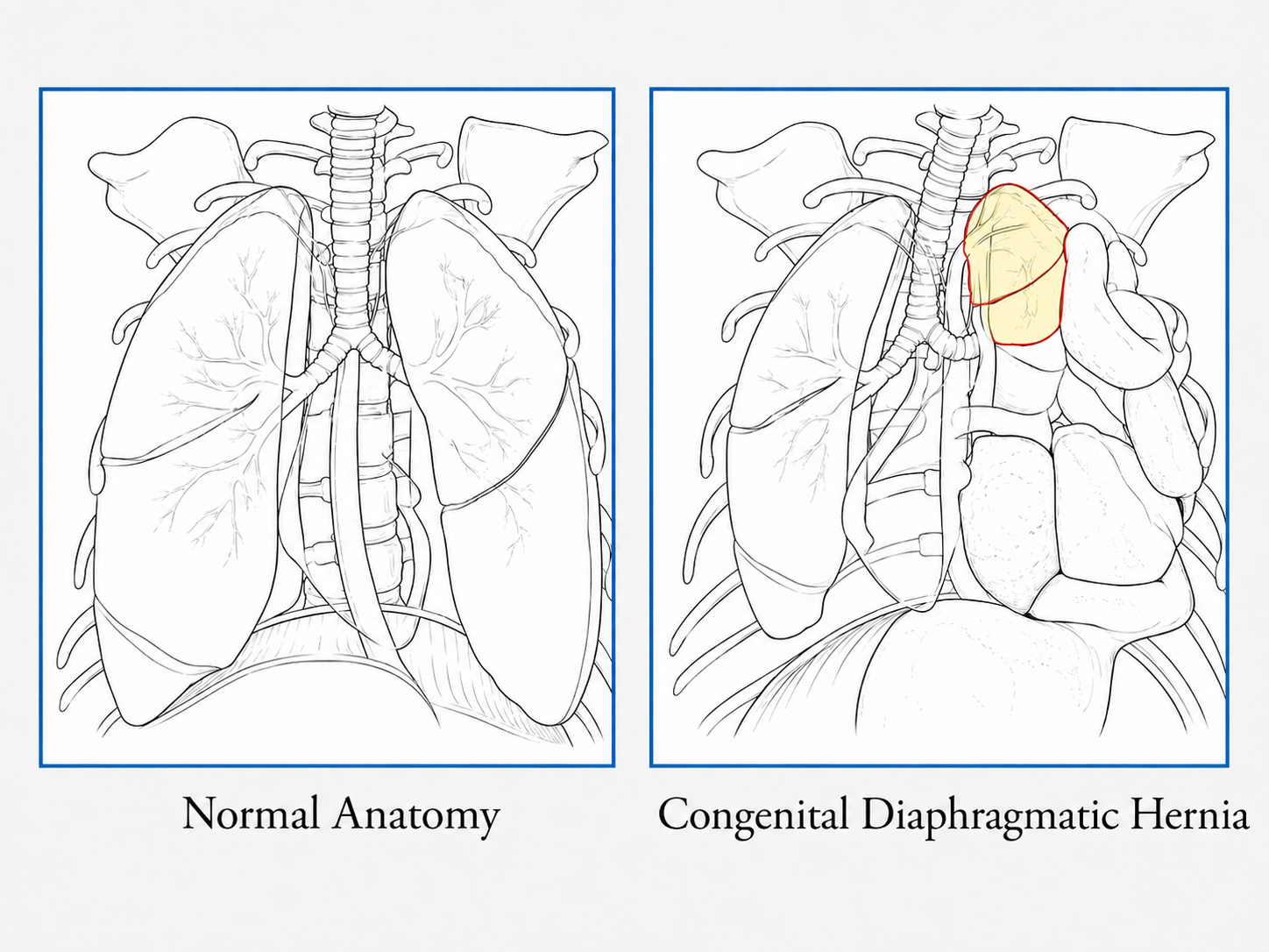 <p>Normal anatomy vs CDH anatomy</p>