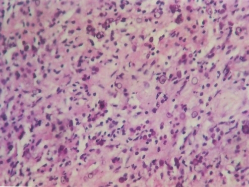 <p>Photomicrograph of Malakoplakia