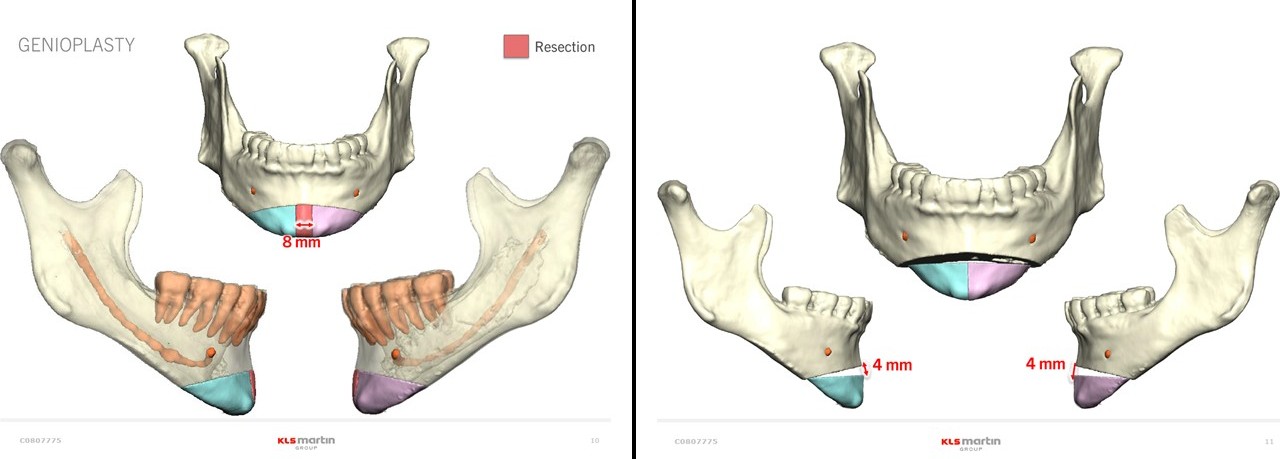 <p>T-Osteotomies for Genioplasty