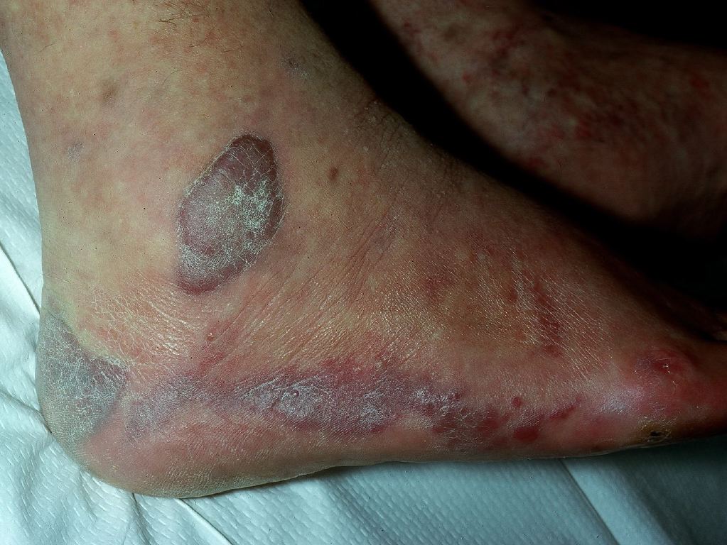 <p>Kaposi Sarcoma.</p>