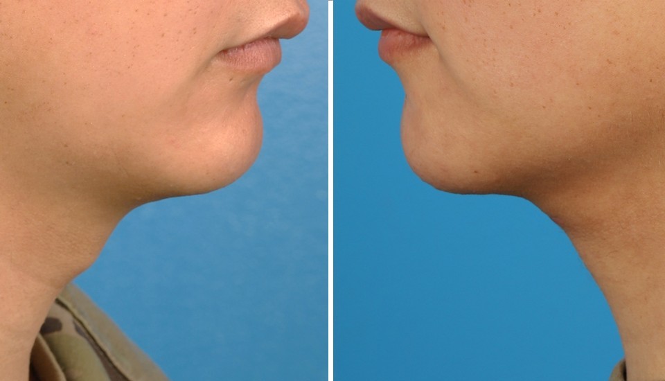 <p>Laryngeal Chondroplasty