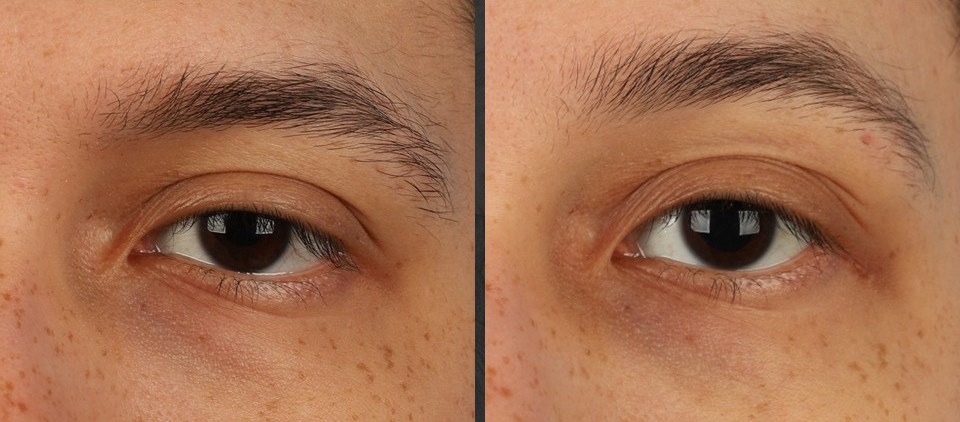 <p>Lateral Tarsal Strip Canthoplasty
