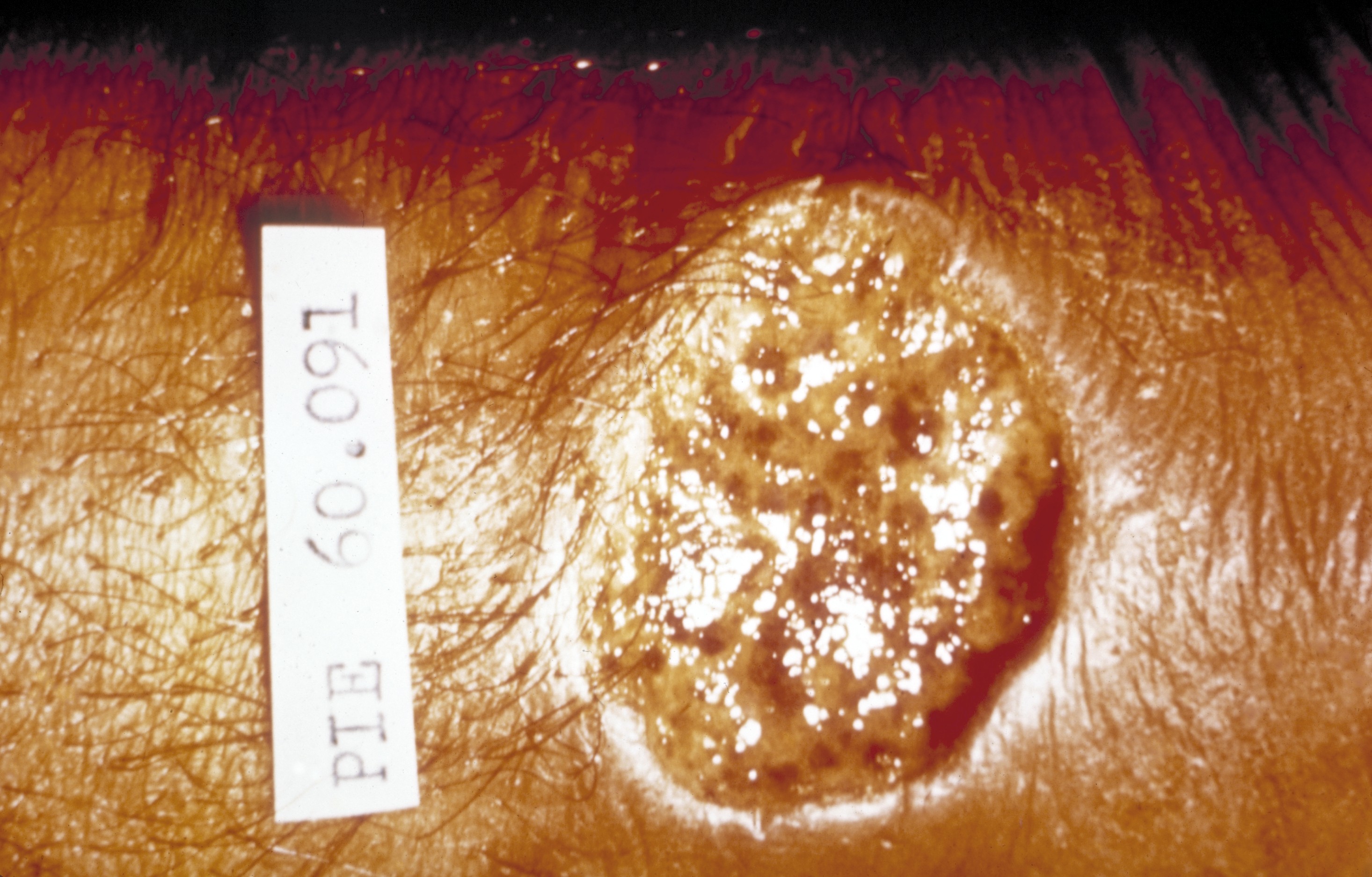 <p>Ulcerative Lesion of Cutaneous Leishmaniasis