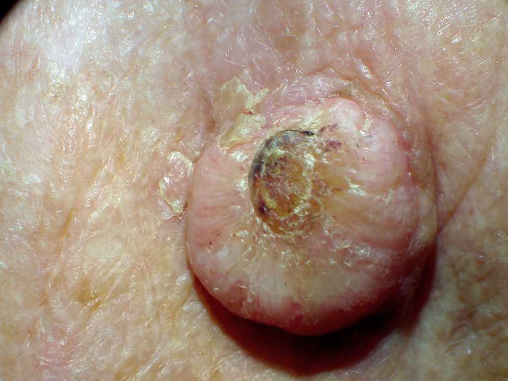 <p>Keratoacanthoma.</p>