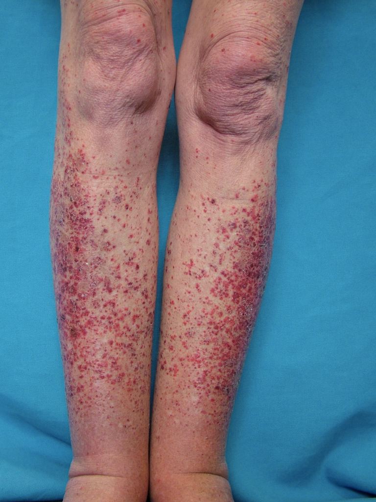 <p>Leukocytoclastic Vasculitis.</p>