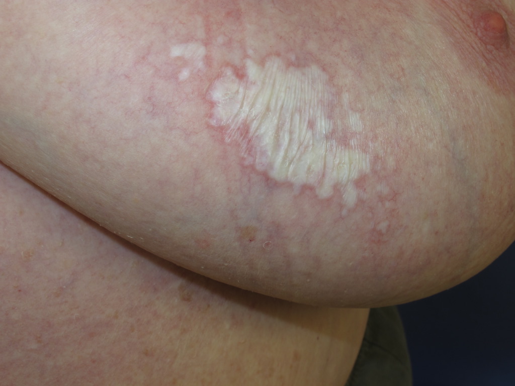 <p>Lichen Sclerosus.</p>