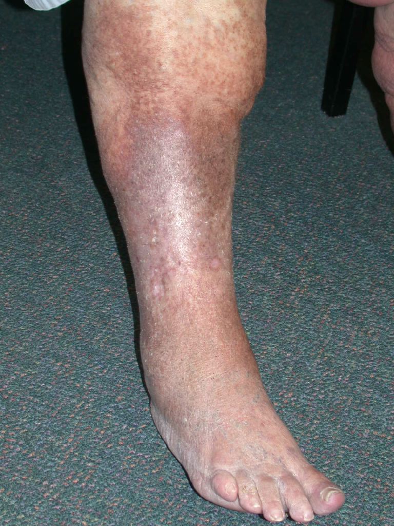 <p>Lipodermatosclerosis.</p>