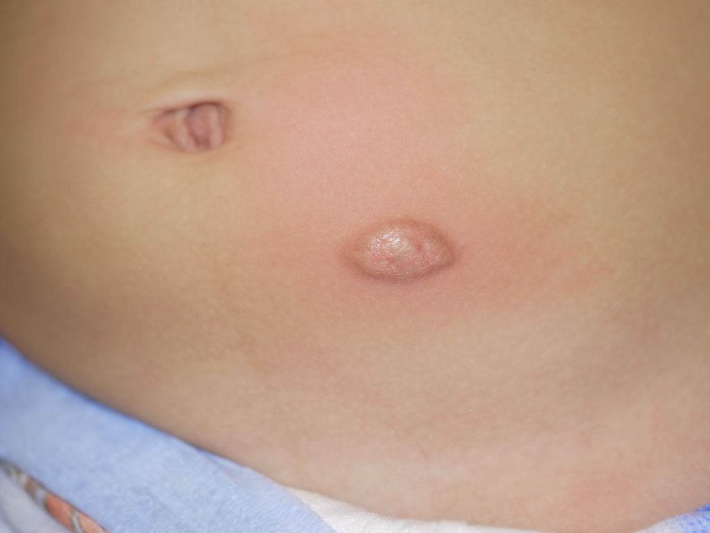 <p>Mastocytoma. A solitary mastocytoma appears as a well-circumscribed, yellow-brown, dome-shaped nodule.</p>