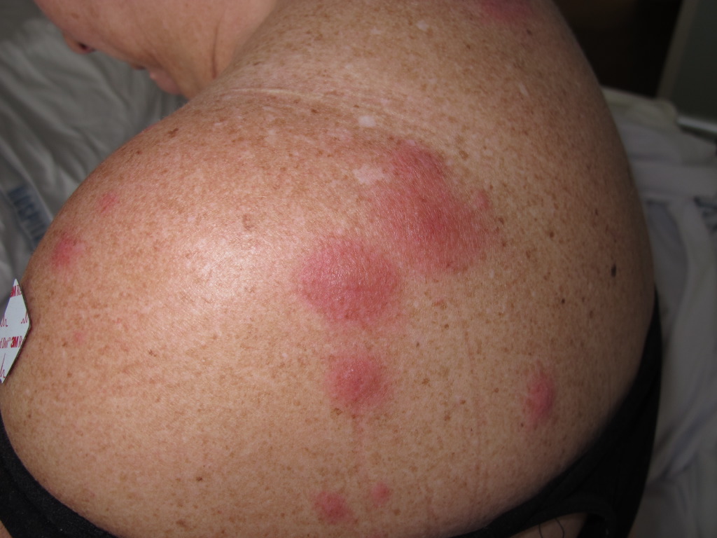 <p>Neutrophic Dermatosis.</p>