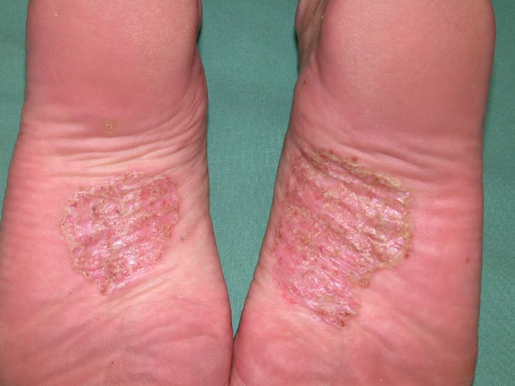 <p>Pustulosis on the Soles