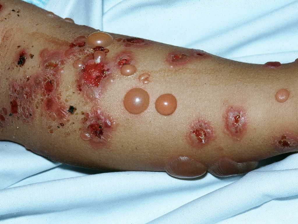 <p>Bullous Pemphigoid