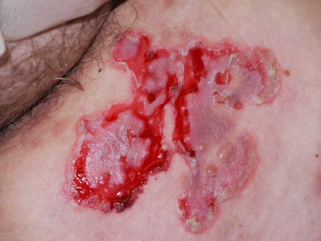 <p>Pemphigus Vulgaris.</p>