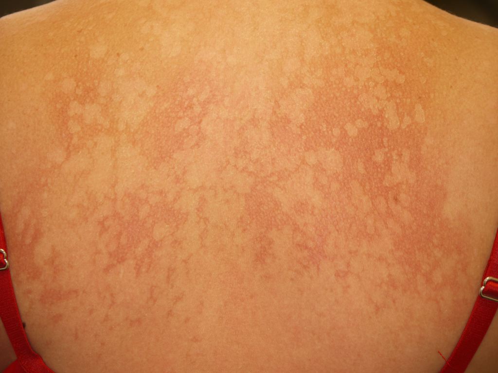 <p>Pityriasis Versicolor.</p>