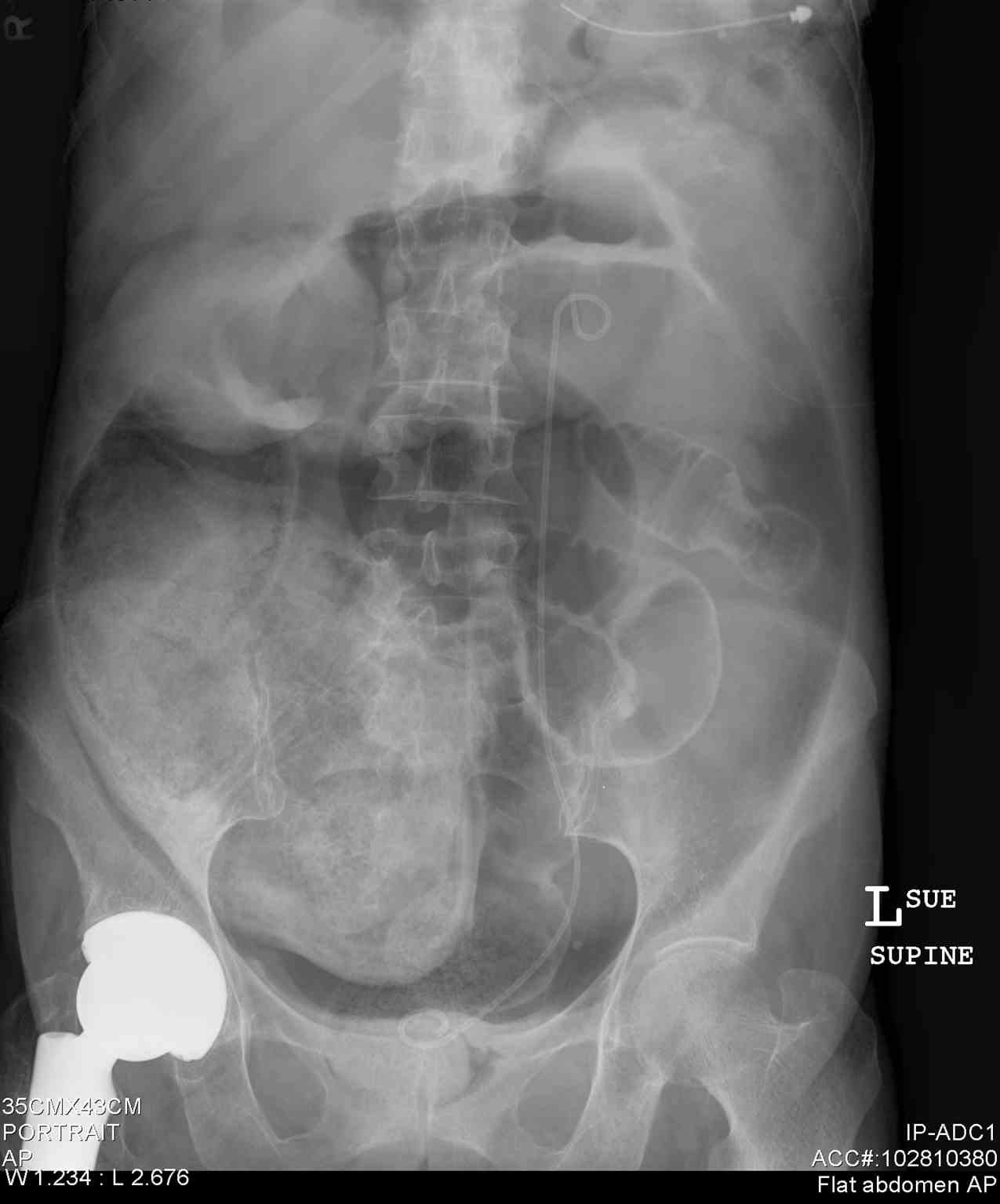 <p>Abdomen With Free Air, Radiograph. This plain film radiograph of the anteroposterior abdomen shows free air.</p>