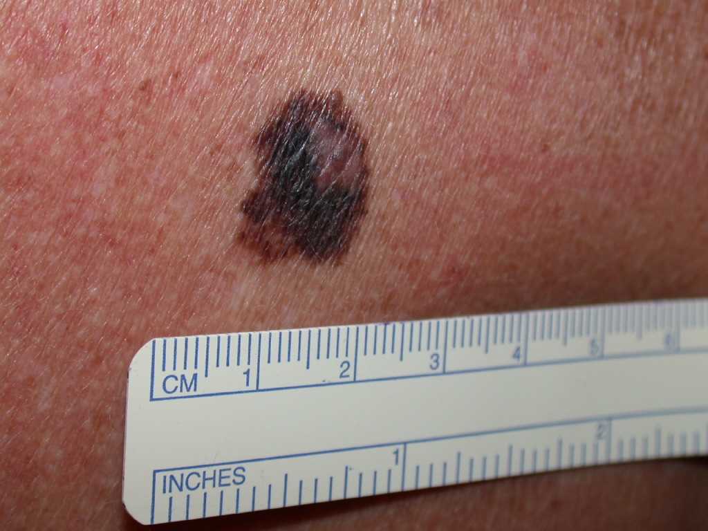 <p>Melanoma.</p>
<p>&nbsp;</p>