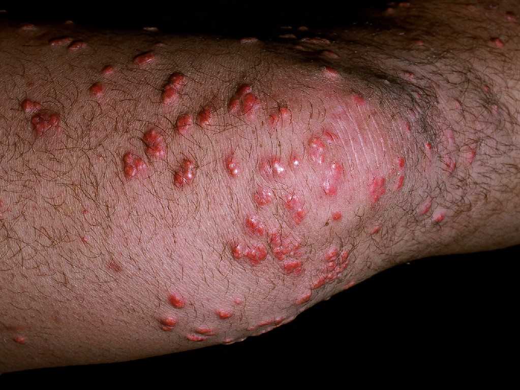 <p>Eruptive Xanthomas