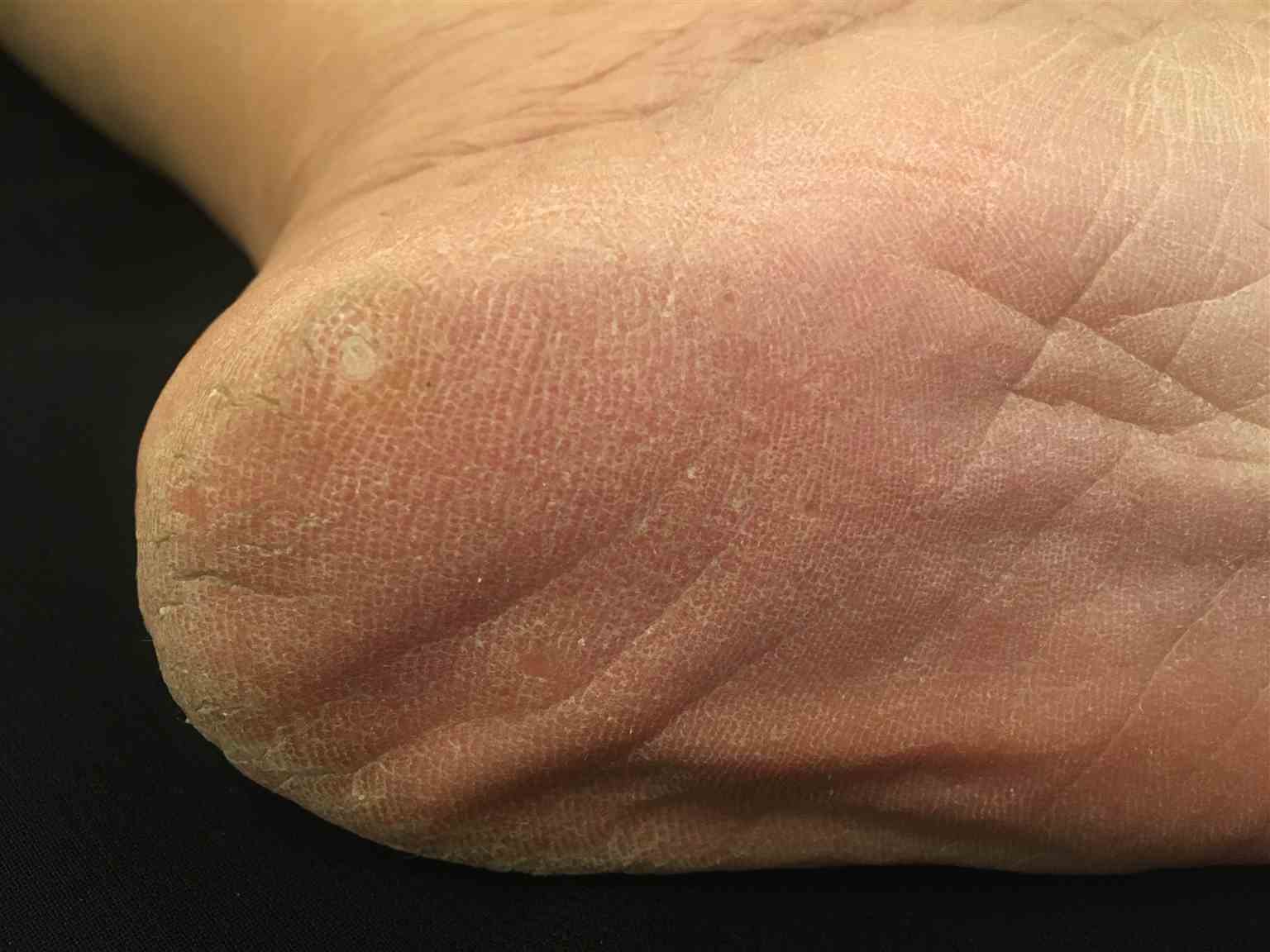 <p>Plantar Corn.</p>