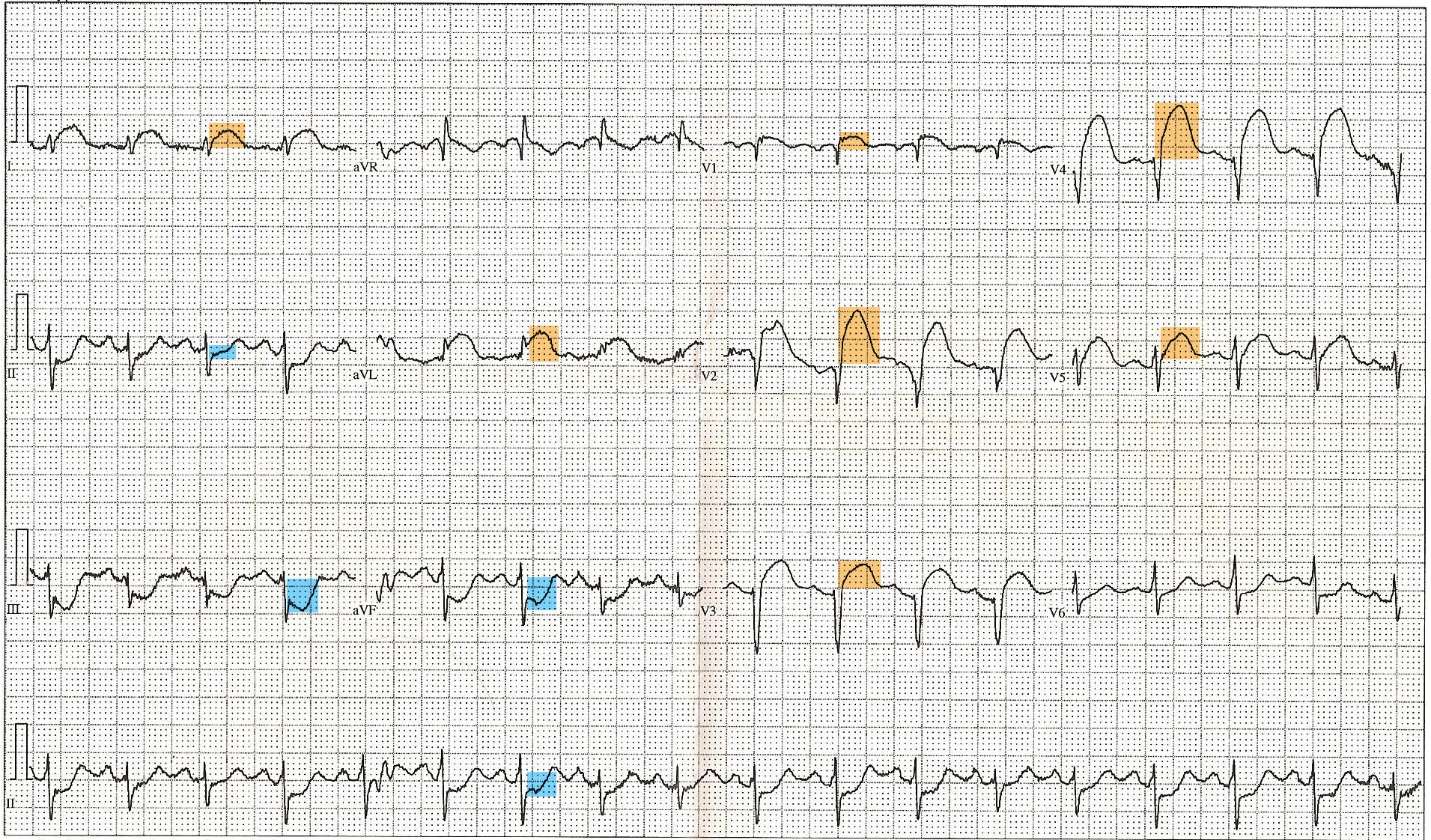 <p>ST-Segment Elevation Myocardial Infarction