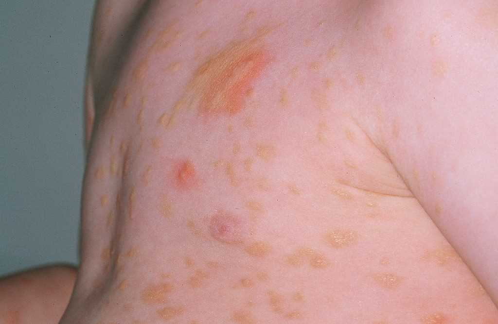 <p>Urticaria Pigmentosa.</p>