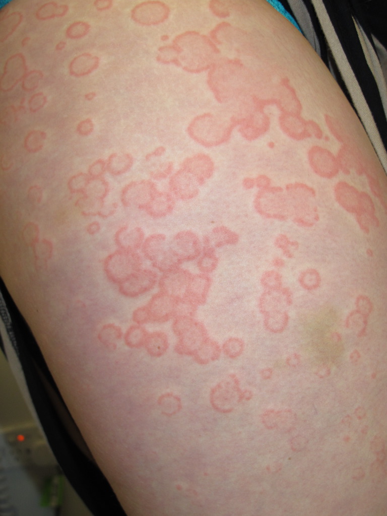 <p>Urticaria, Upper Arm