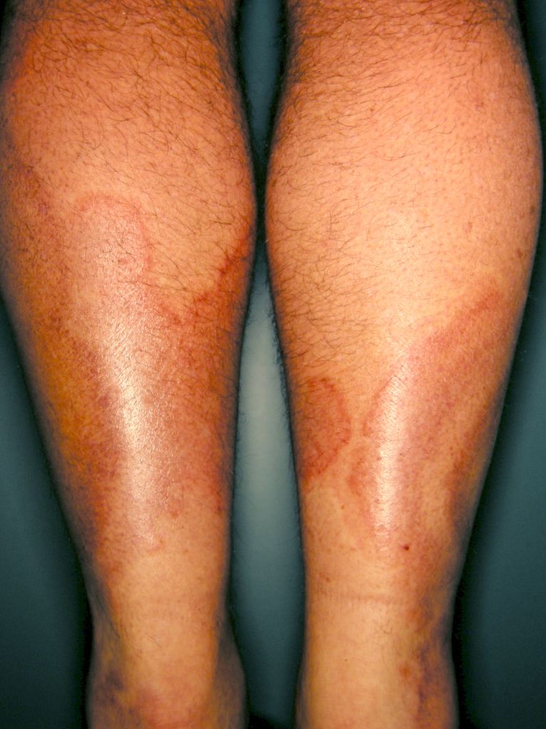 <p>Urticarial Vasculitis