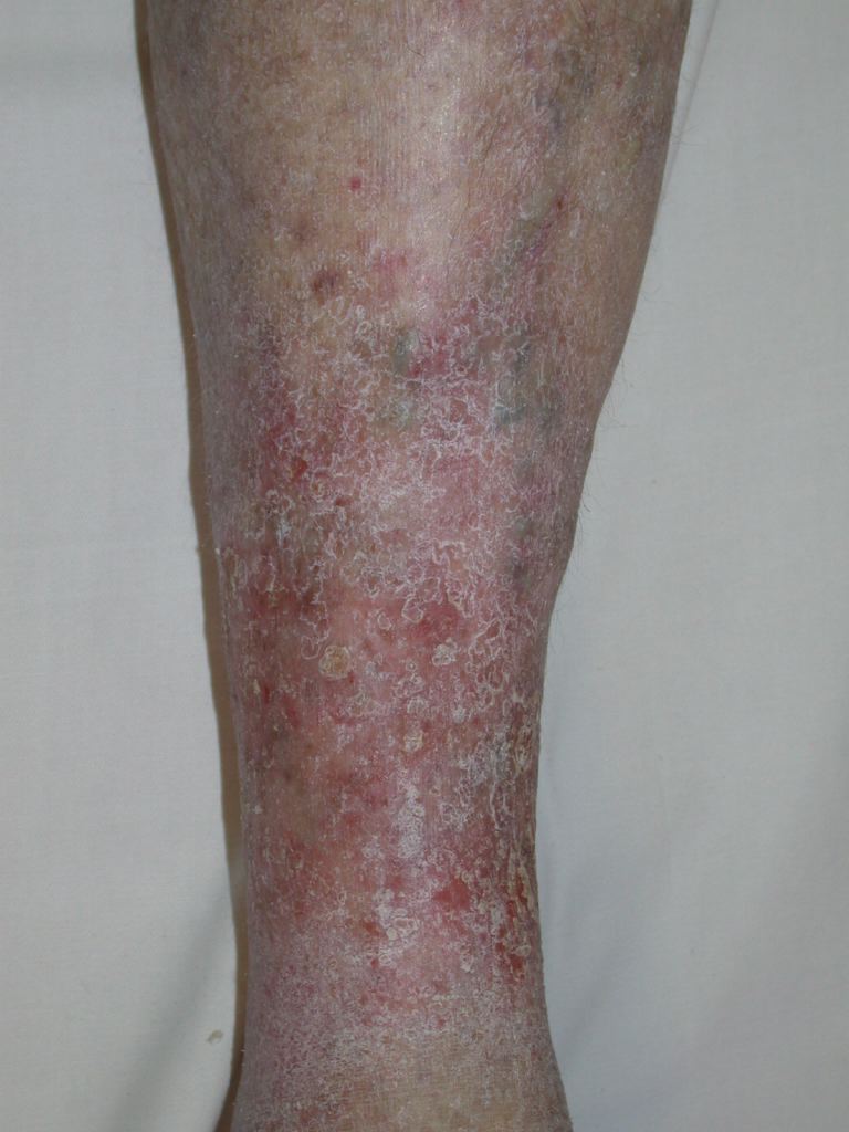 <p>Venous Eczema.</p>