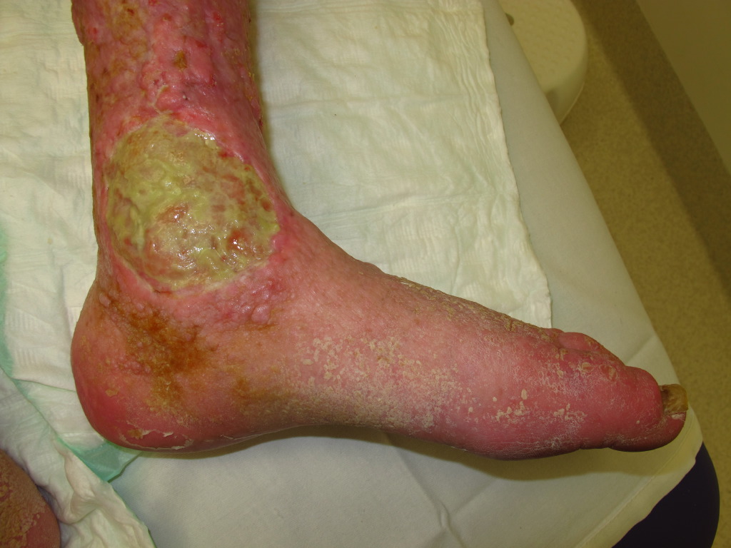 <p>Venous Stasis Ulcer