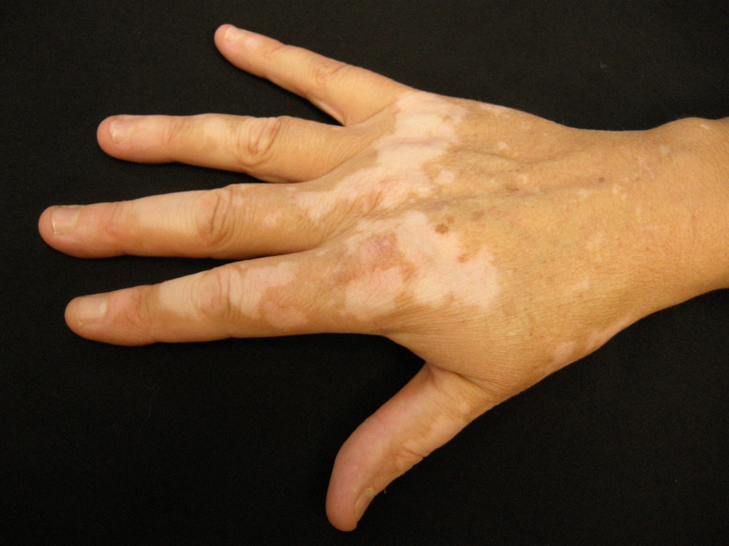 <p>Vitiligo, Hand.</p>